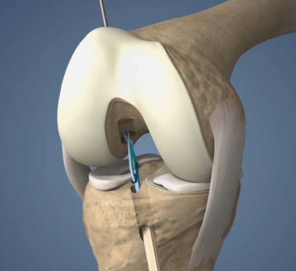 ACL Reconstruction