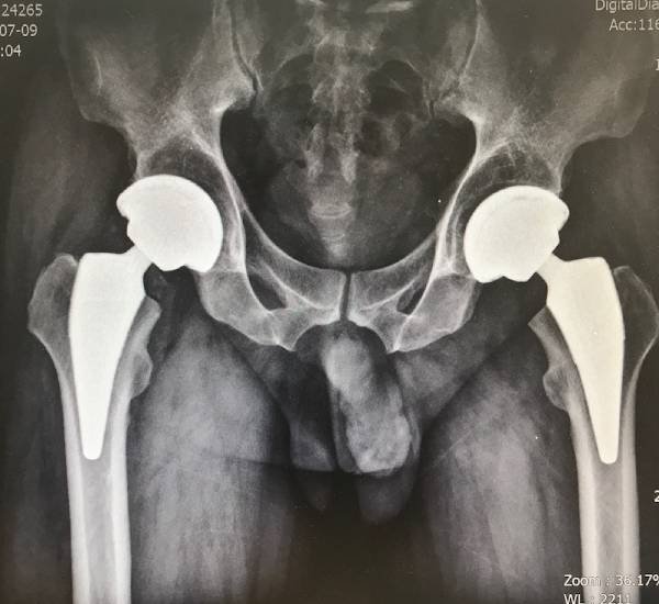 Hip Replacement