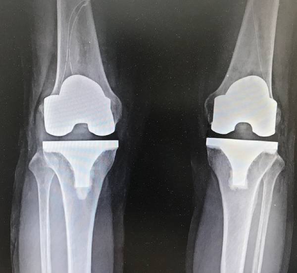 Knee Replacement