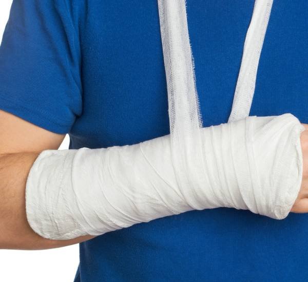 Plaster Cast
